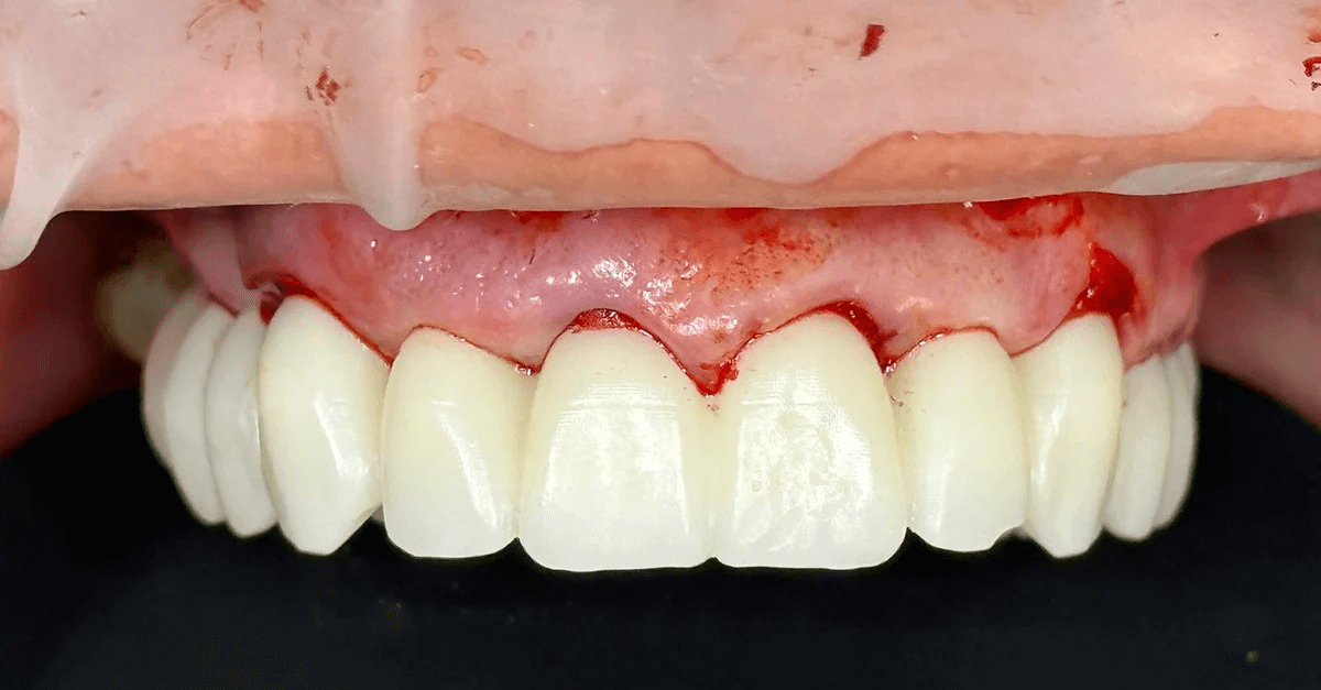 A closer look at dental monochromatic PMMA applications