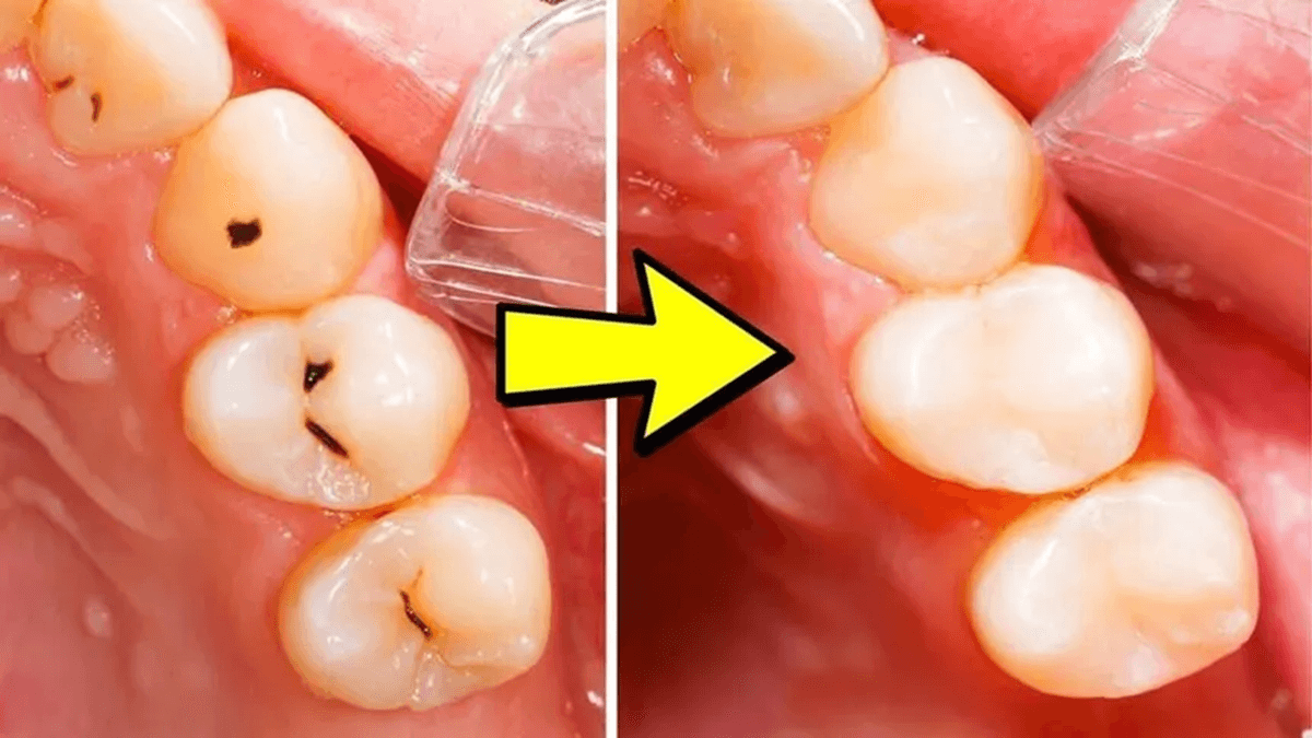 Cavities Before and After treatment