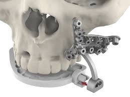 3D printed surgical guides
