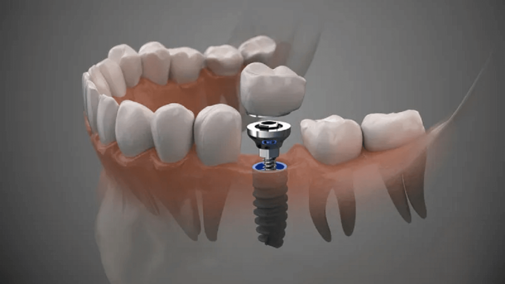 A 3D dental implant model showing dental implant procedure and its placement into the jawbone
