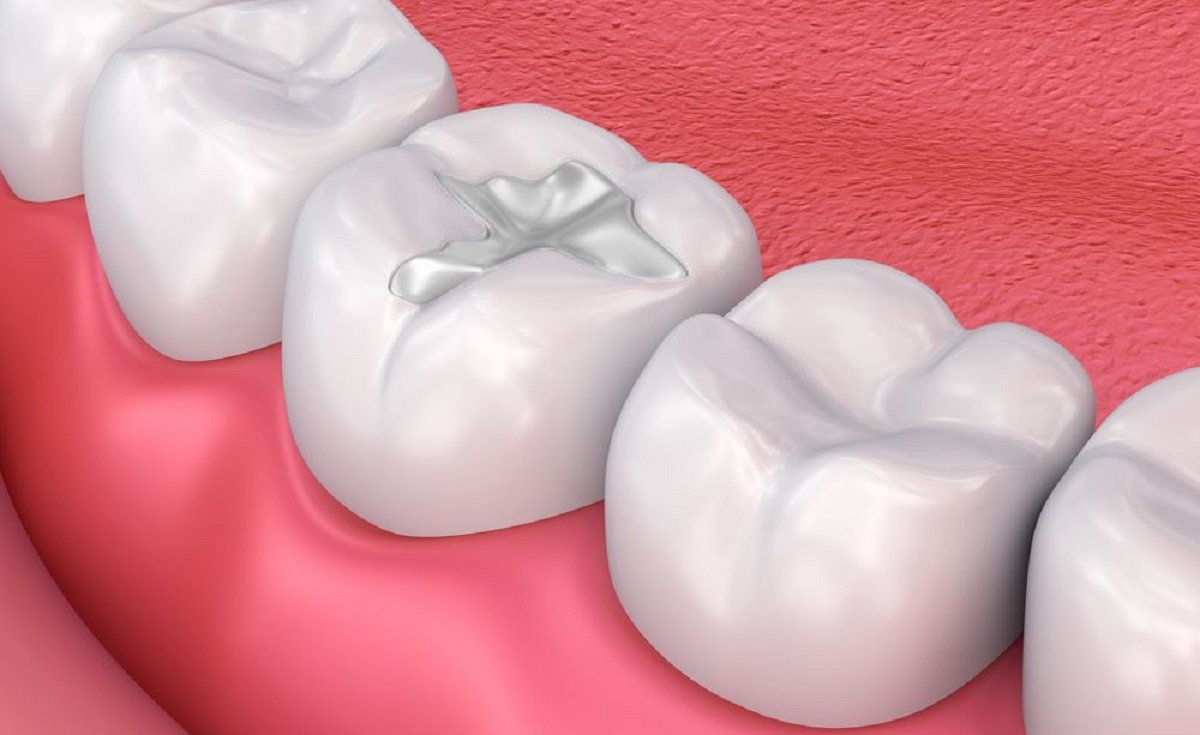 A 3D model of 3 cavities filled with different types of dental fillings and dental filling materials.