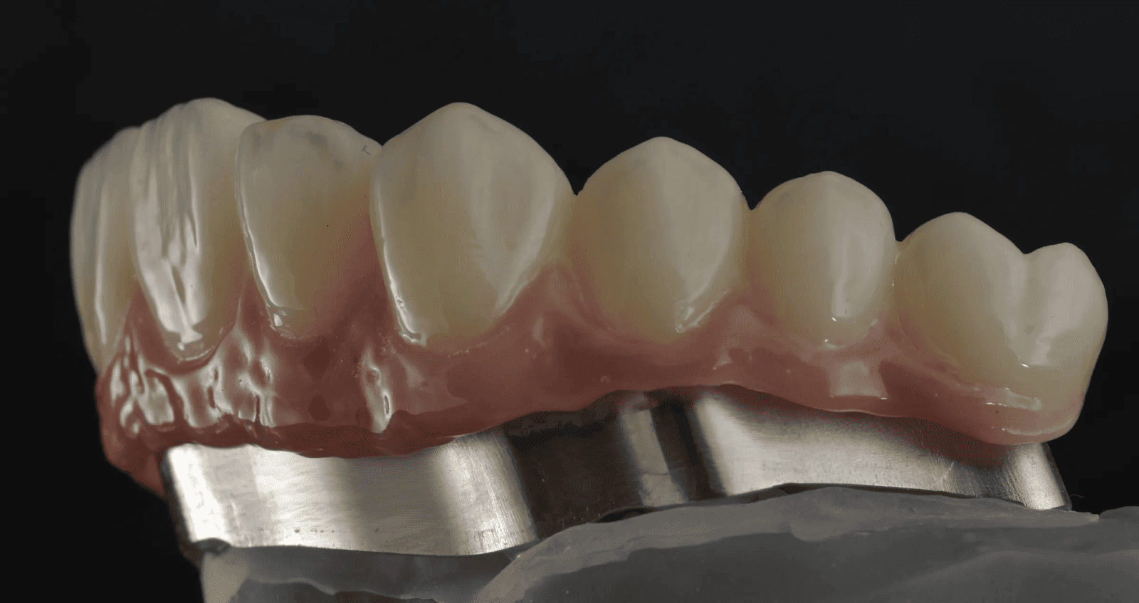 A beautifully crafted Zirconia Restoration that had Biomic Stain And Glaze applied.