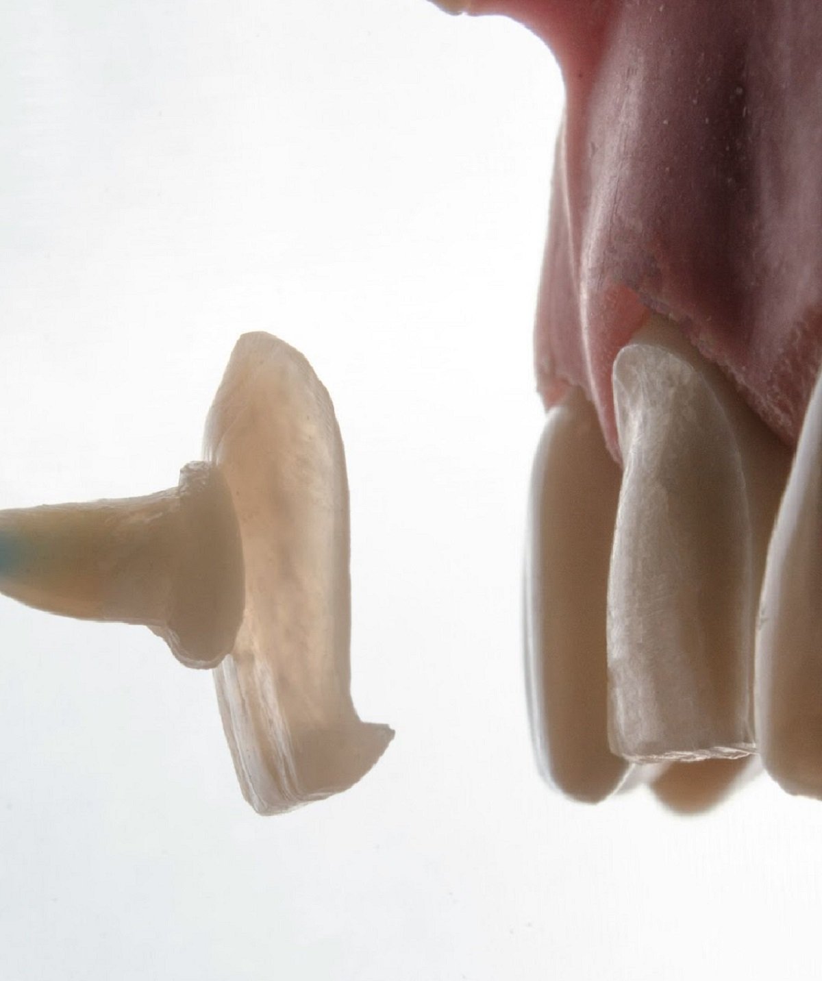 A close-up look of dental veneer