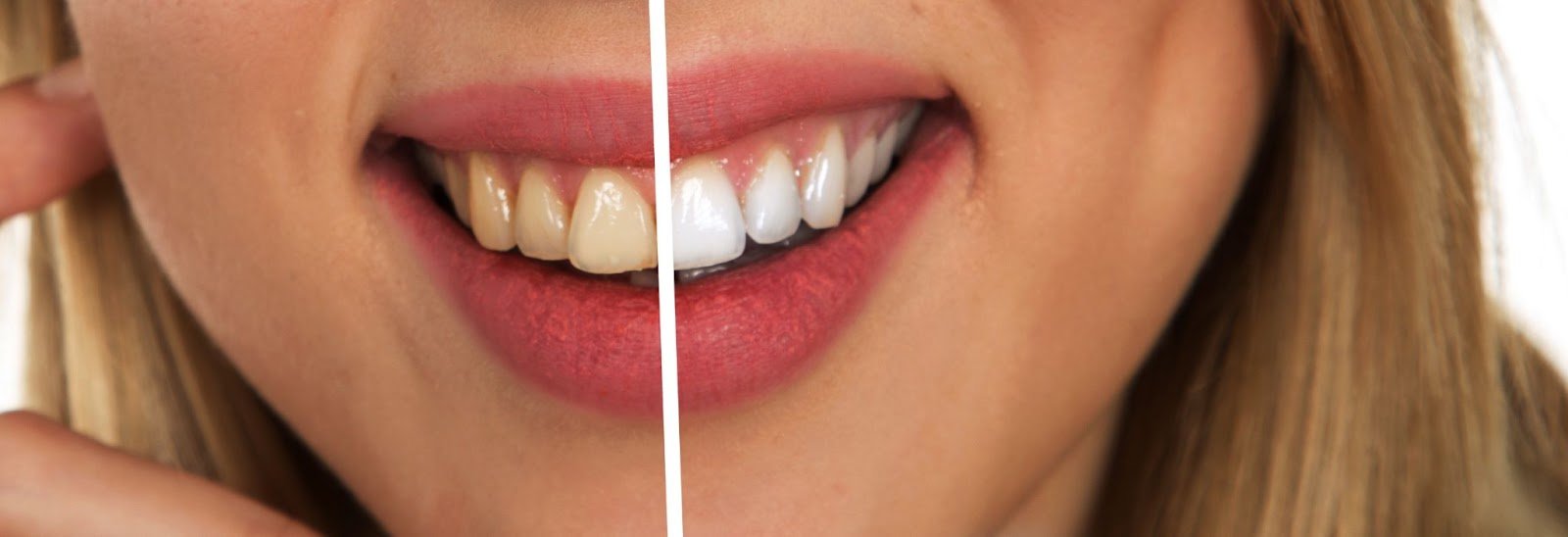 A patient smiling before and after Aidite Stain treatment