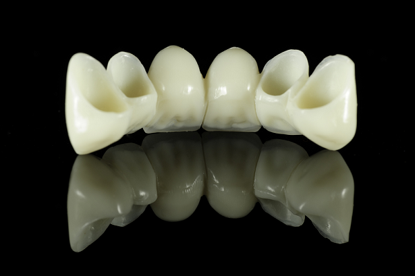 All ceramic dental bridge