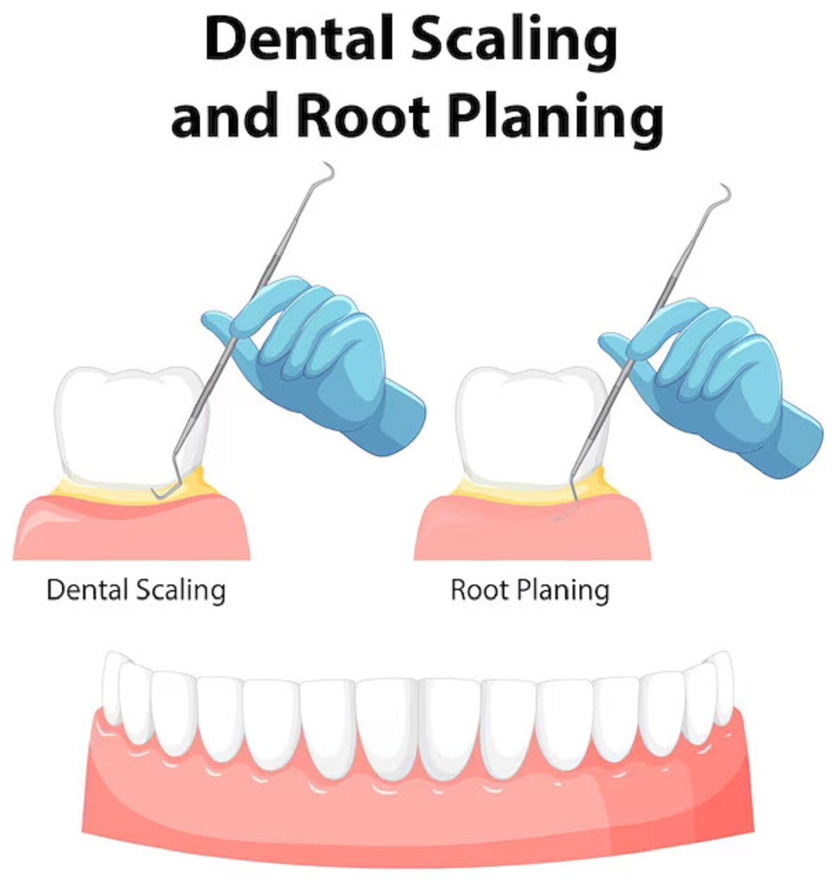 An illustration of a dental scaling and root planing procedure