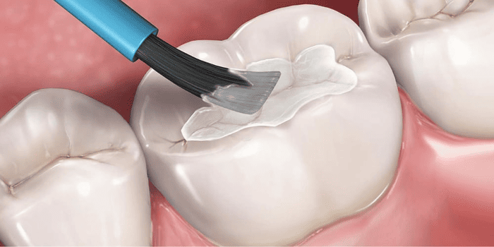 Application of dental sealant