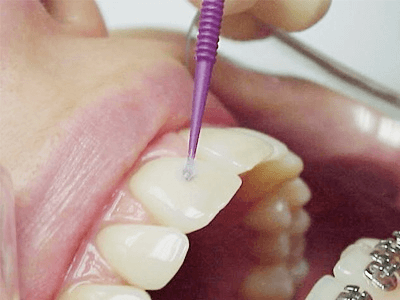 Applying dental adhesive on teeth