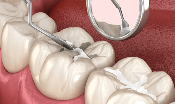 Applying dental sealants on teeth