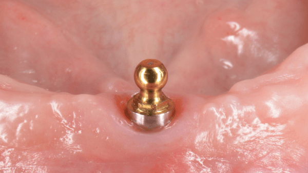 Ball retained dentures