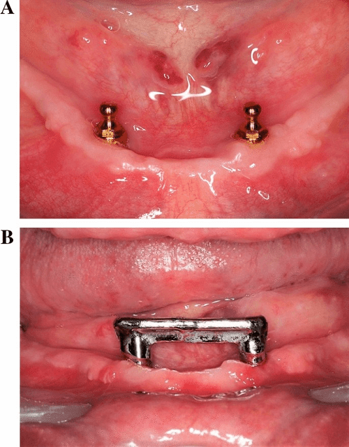 Ball-retained vs Bar-retained Dentures