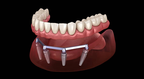Bar-retained dentures