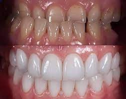 Before and after zirconia bonding treatment