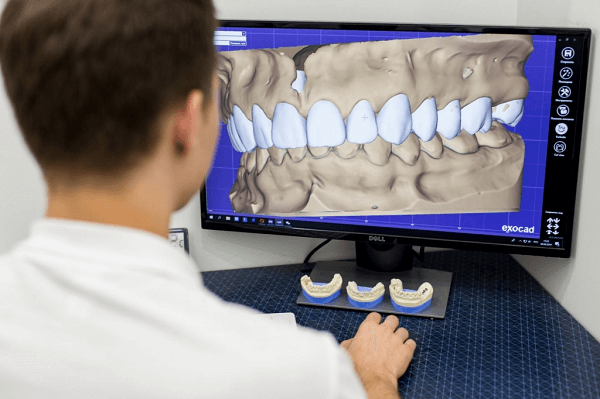 Benefits of CAD/CAM Digital Dentistry