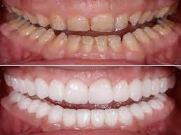 Benefits of Dental Surgery
