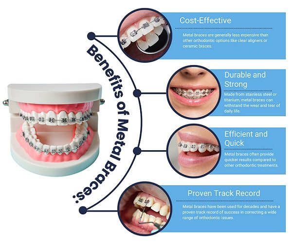 Benefits of Metal Dental Braces