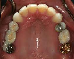 Benefits of Partial Dentures for Back Teeth