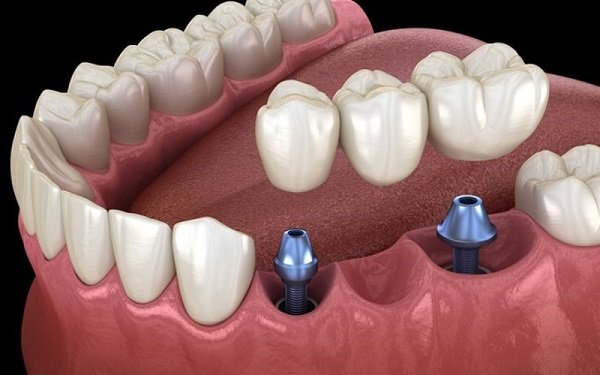 Benefits of Splinted Dental Crowns