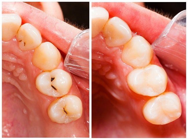 Benefits of using dental resin