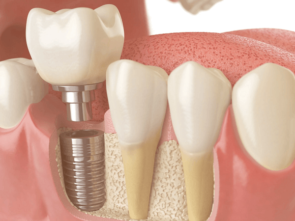 Bone Graft for Dental Implant