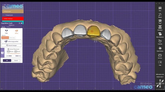 CAD/CAM Denture Design with Aidite