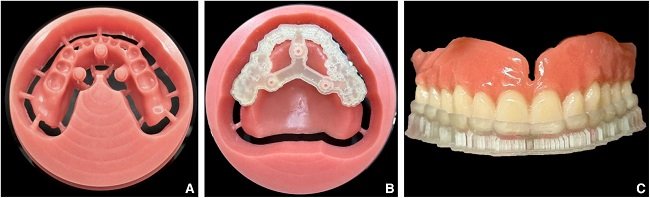 CAD/CAM denture design technology