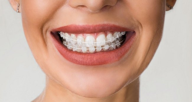 Ceramic Braces