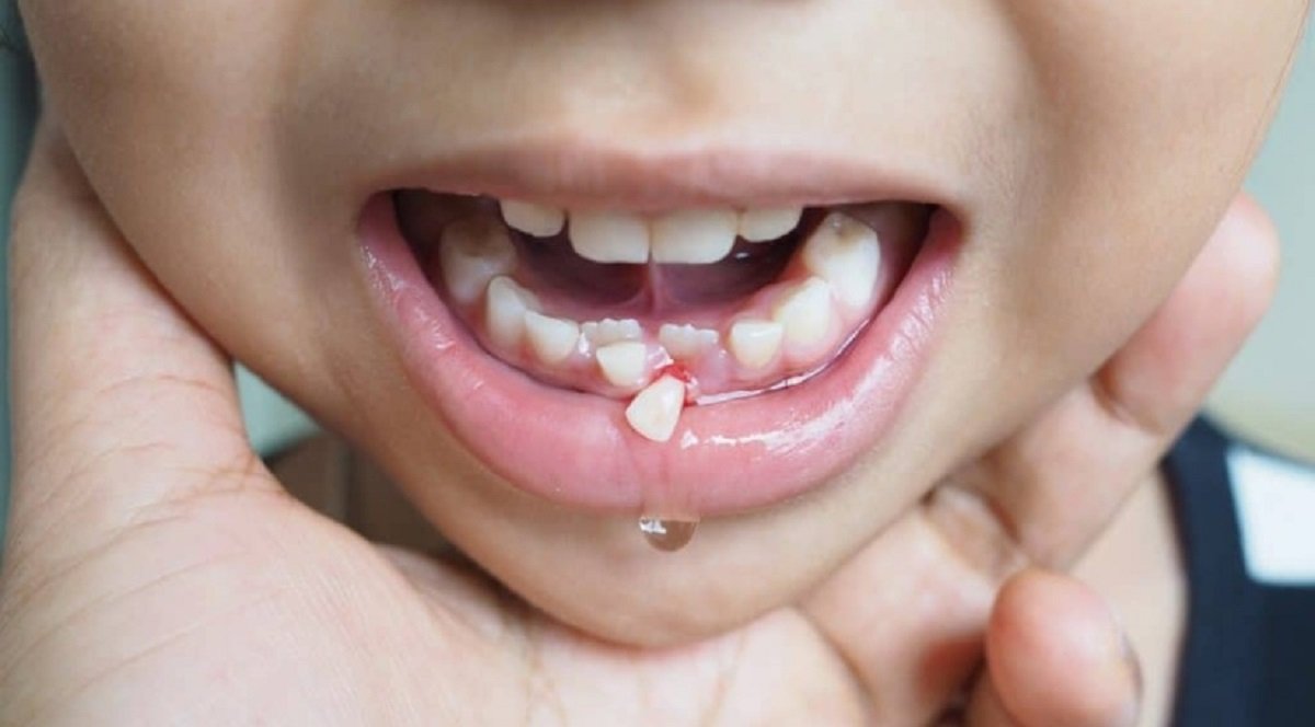 Child with Dental Injury