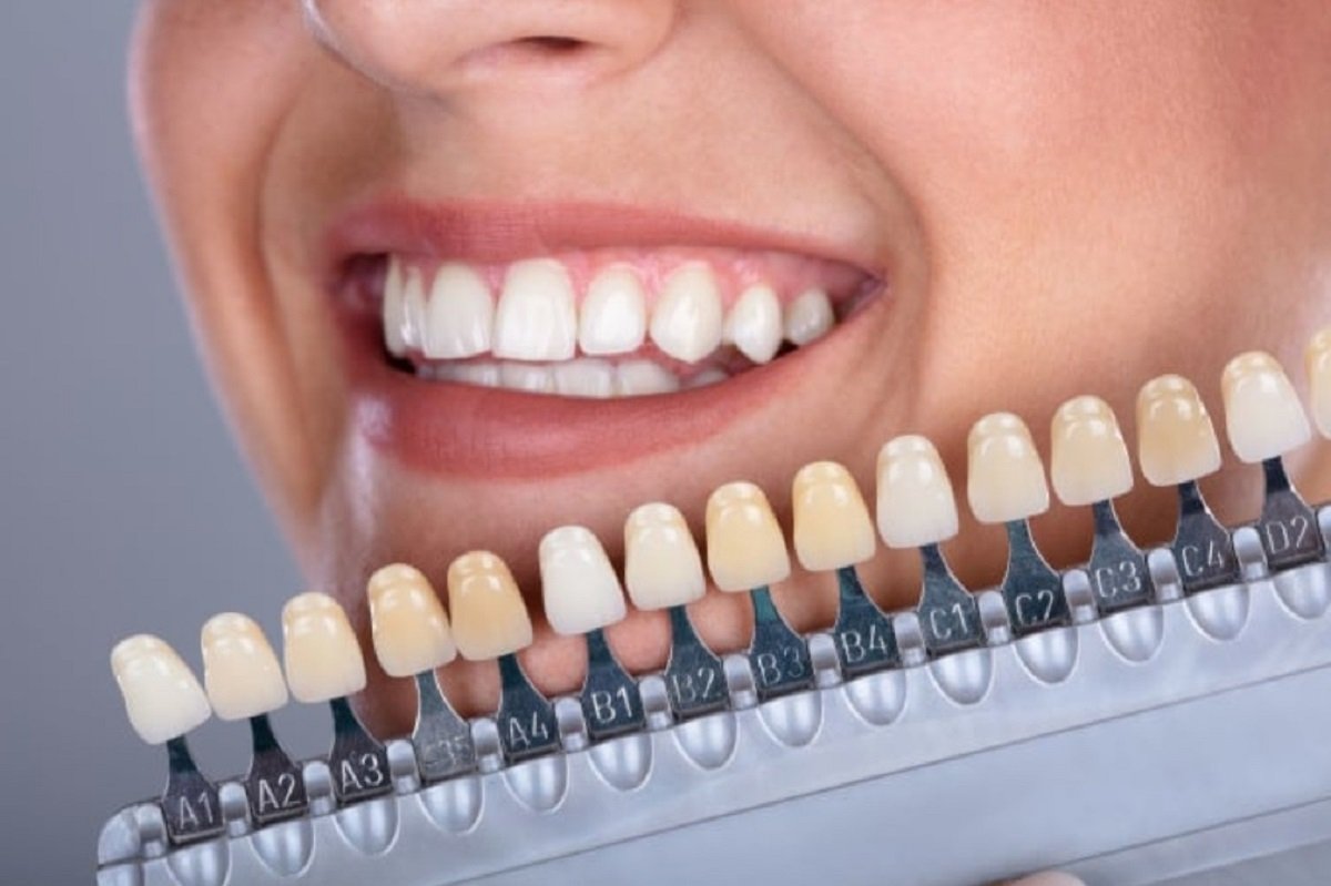 Choosing the Right Dental Veneer Colors: A Comprehensive Guide