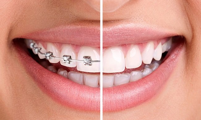 Clear Brackets Vs Metal Brackets Braces