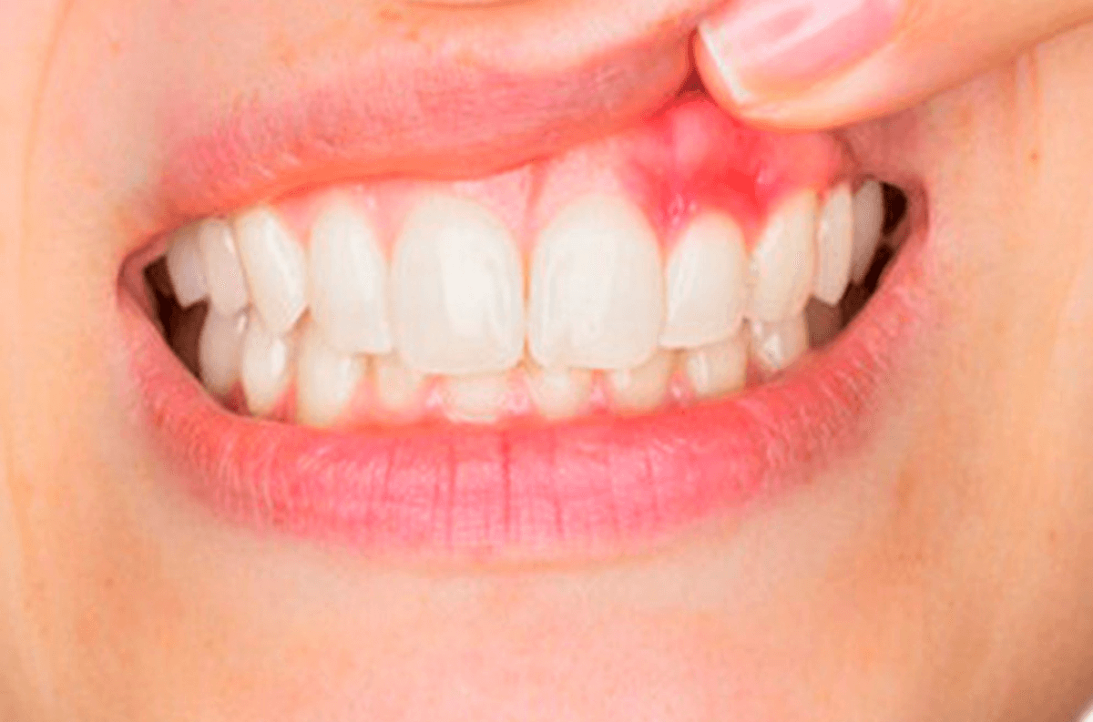 Close-up of red, swollen gums indicating early gum disease symptoms