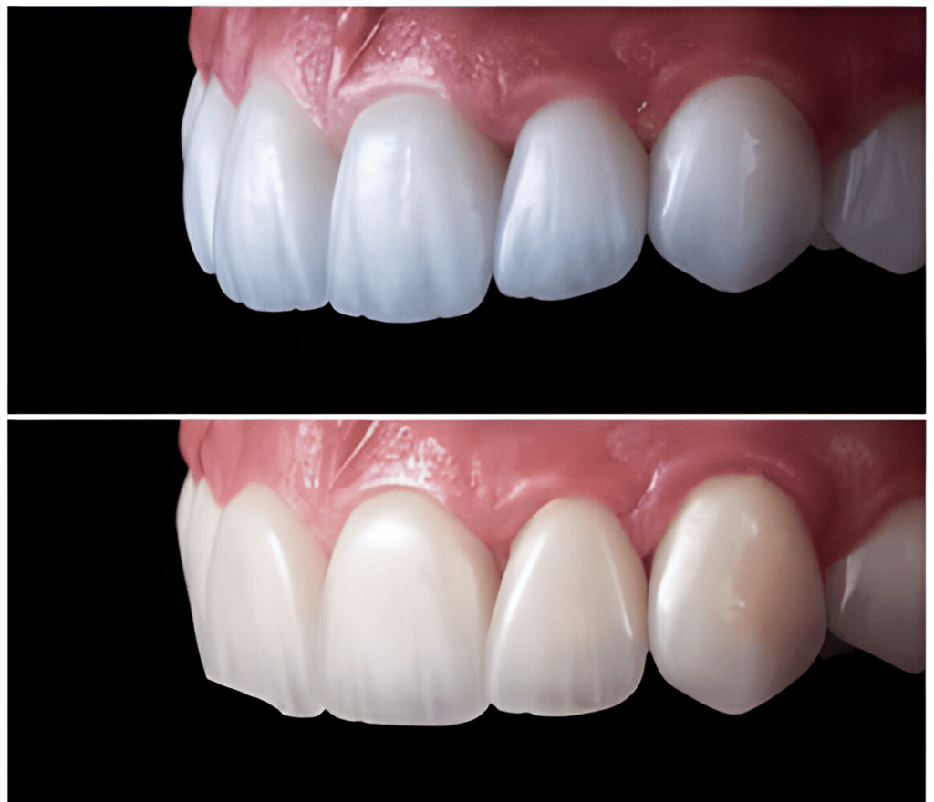 Comparison of E-mx vs Zirconia Veneers