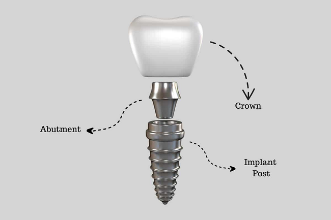 Components of Dental Implant