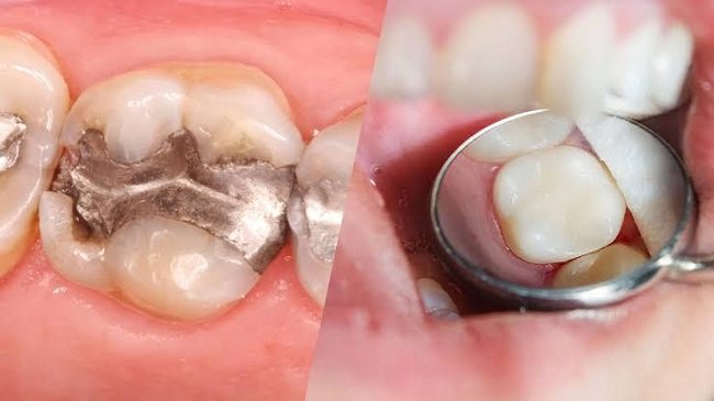 Composite vs. Amalgam