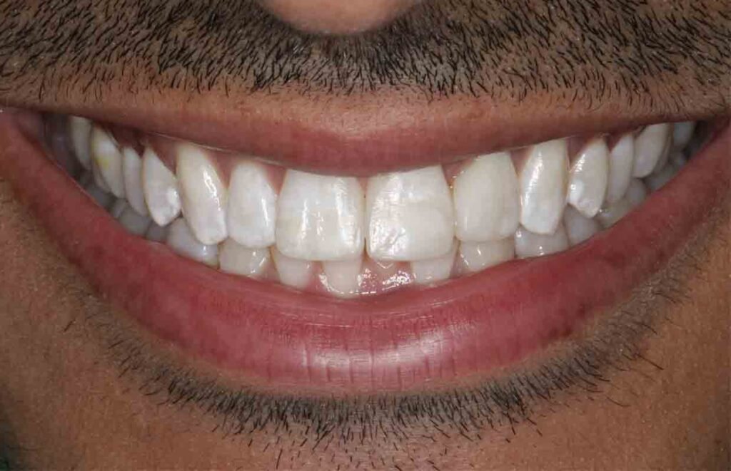 Dental Bonding Look