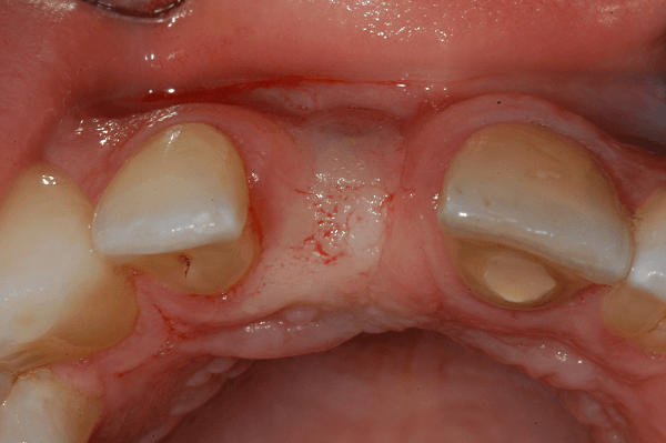 Dental Bone Graft Healing