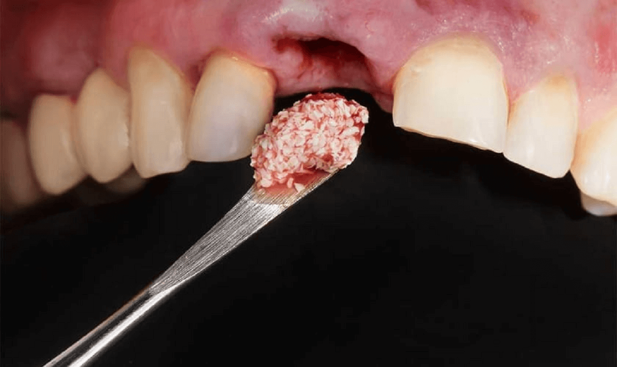 Dental Bone Graft