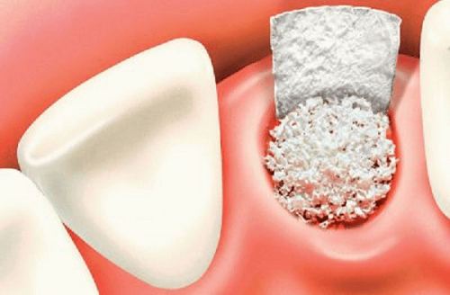 Dental Bone Grafting Material