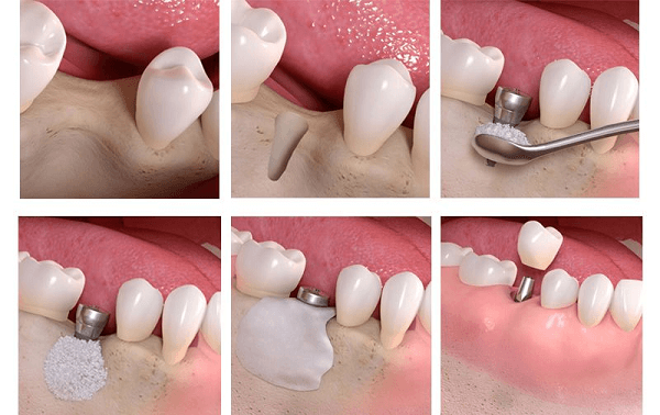 Dental Bone Grafting Steps