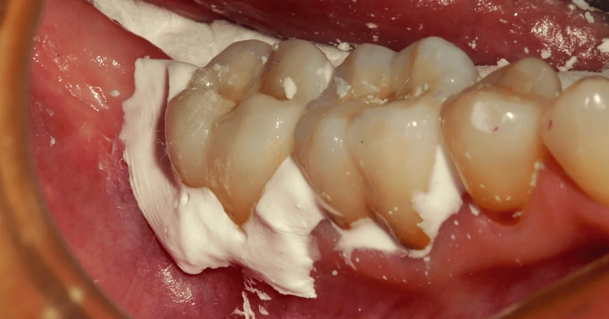 Dental Bridge Adhesive