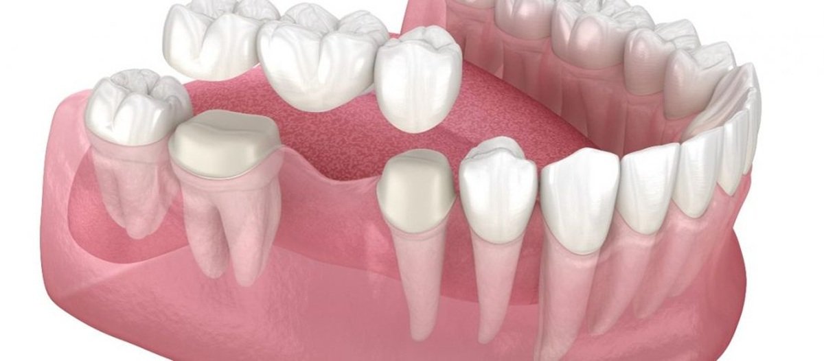 Dental Bridges 