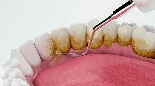 Dental Cleaning