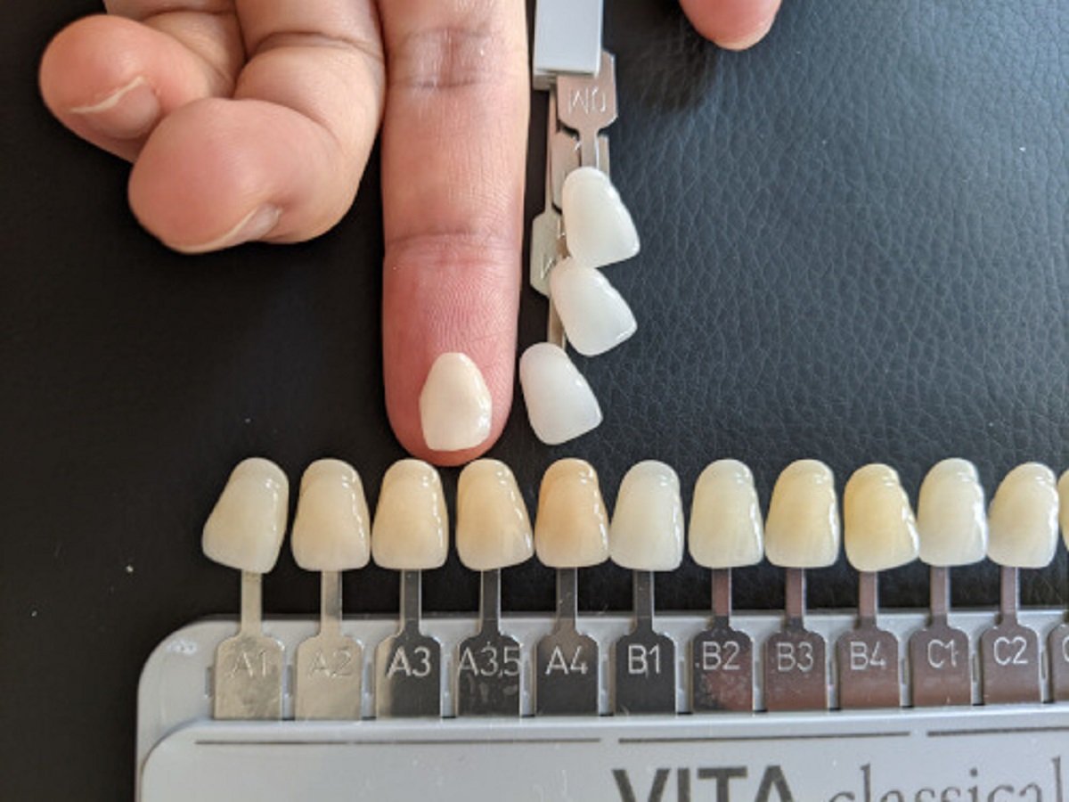 Dental Crown Color Chart Guide for Accurate Shade Matching