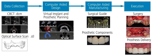 Dental Implant Digital Workflow