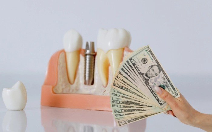Dental Implant Pricing Guide: Affordable Tips