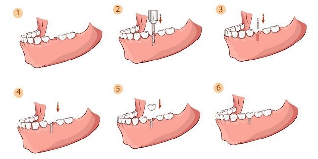 Dental Implant Process Step by Step