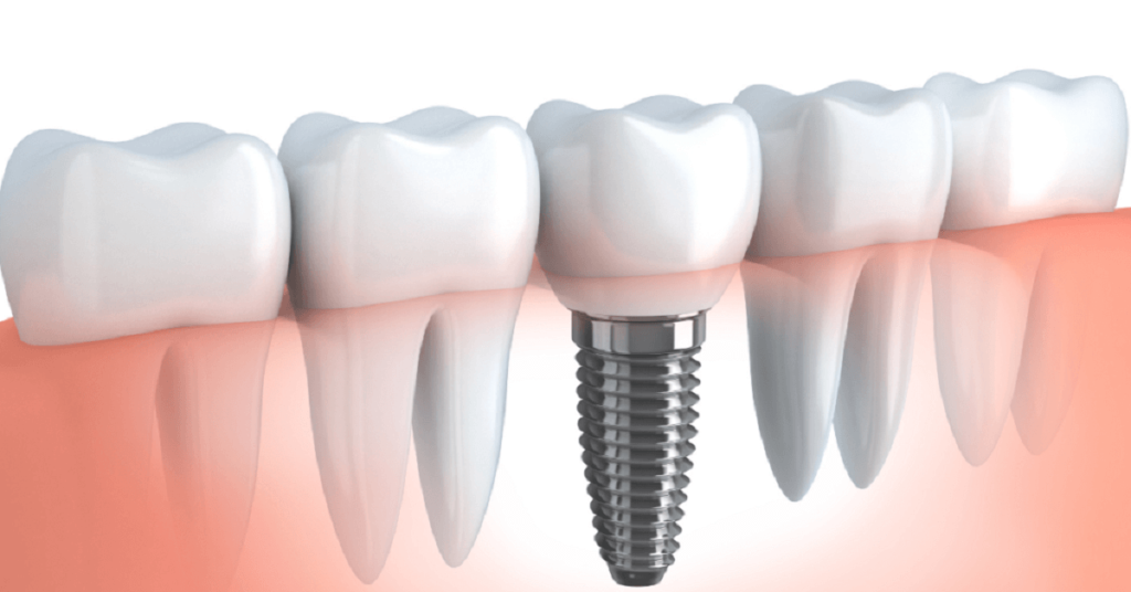 Dental Implant Recovery