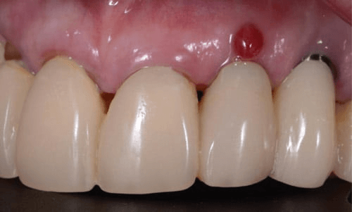 Dental Implant Recovery Complications