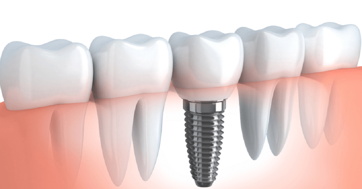 Dental Implant Recovery