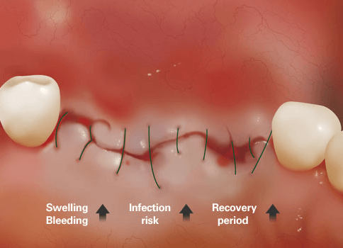 Dental Implant Recovery